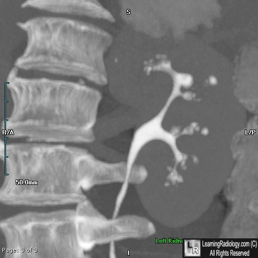 Renal Papillary Necrosis